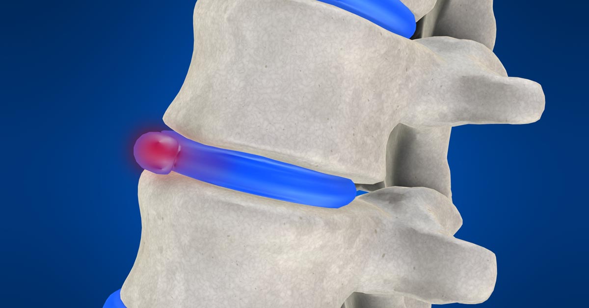 Highland Park, Saint Paul, Minnesota non-surgical disc herniation treatment