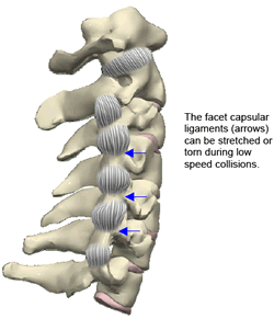 Areas of ligament injury