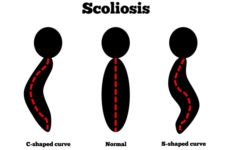 St. Paul, MN scoliosis treatment